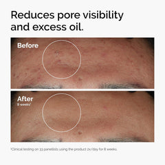 The Ordinary Niacinamide 10% + Zinc 1% 30ml | Oil Control & Blemish Serum