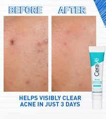 Salicylic Acid, Acne Treatment, Pore Refining Gel, Makeupstashpk