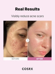 COSRX The Niacinamide 15 Serum 20ML – 15% Niacinamide Serum for Pores, Acne & Oil Control