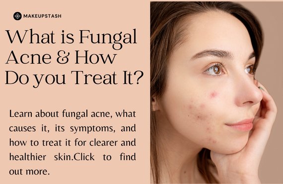 What is Fungal Acne & How Do You Treat It - Makeup Stash Pakistan