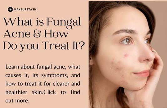 What is Fungal Acne & How Do You Treat It - Makeup Stash Pakistan