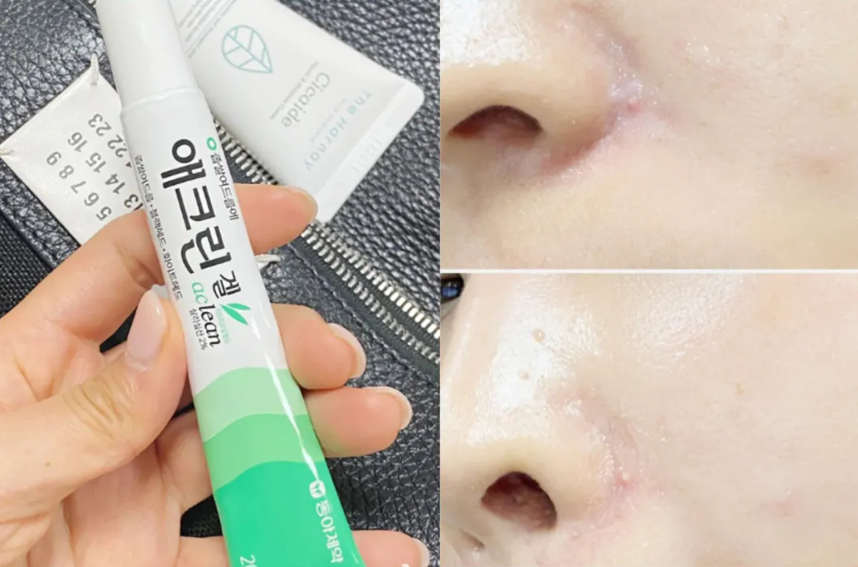  Acne Treatment Gel , Pimples , Blackheads , Oily Skin, Makeup Stash Pakistan