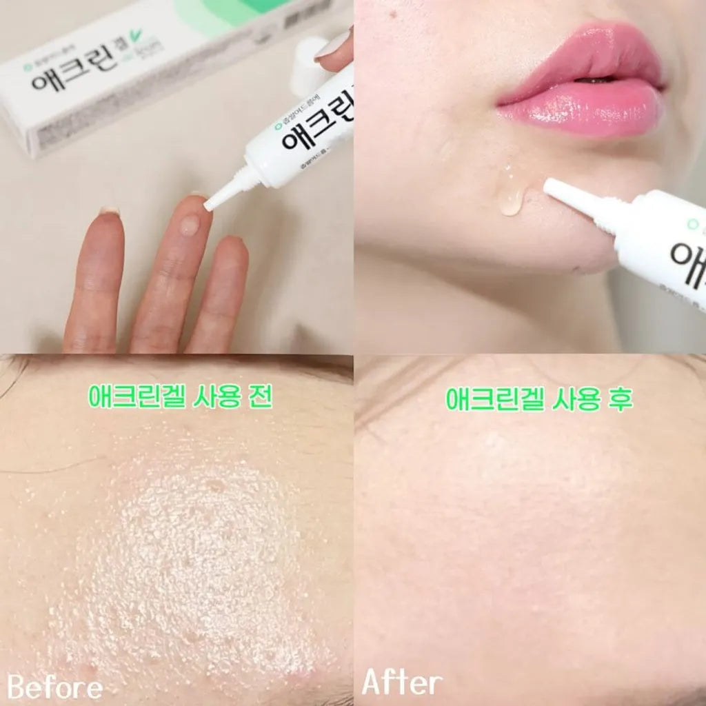  Acne Treatment Gel , Pimples , Blackheads , Oily Skin, Makeup Stash Pakistan