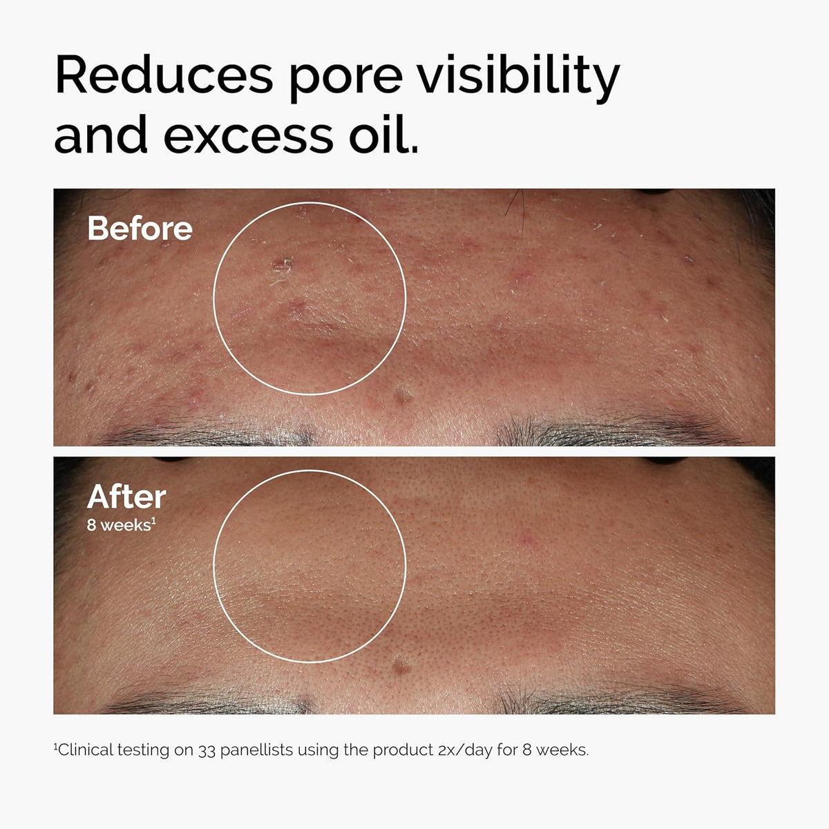 The Ordinary Niacinamide 10% + Zinc 1% 30ml | Oil Control & Blemish Serum