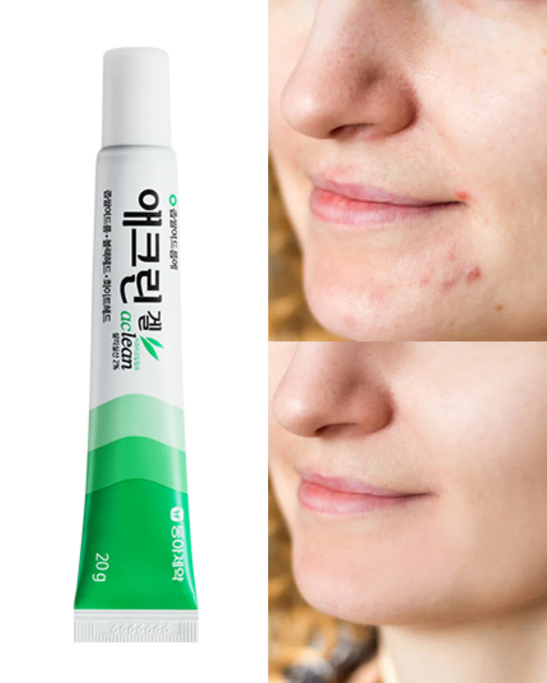  Acne Treatment Gel , Pimples , Blackheads , Oily Skin, Makeup Stash Pakistan