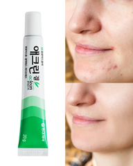  Acne Treatment Gel , Pimples , Blackheads , Oily Skin, Makeup Stash Pakistan