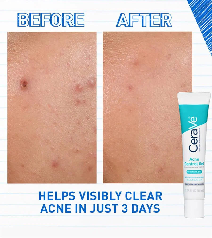 Salicylic Acid, Acne Treatment, Pore Refining Gel, Makeupstashpk