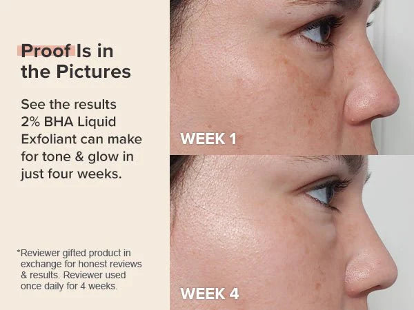 Blackhead Treatment, Pore Minimizer, Acne Solution, Chemical Exfoliant, Travel Size Skincare, Mini Exfoliant, Clear Skin Routine - Makeup Stash Pakistan